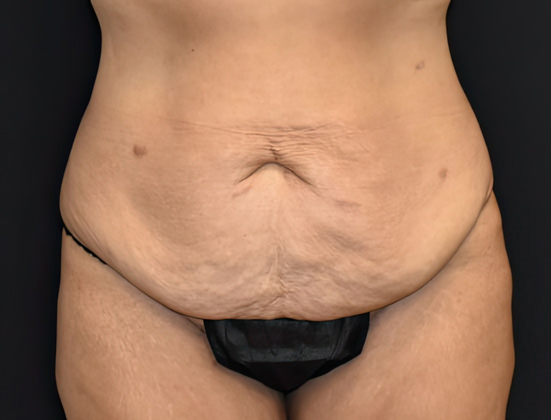 Tampa patient before tummy tuck