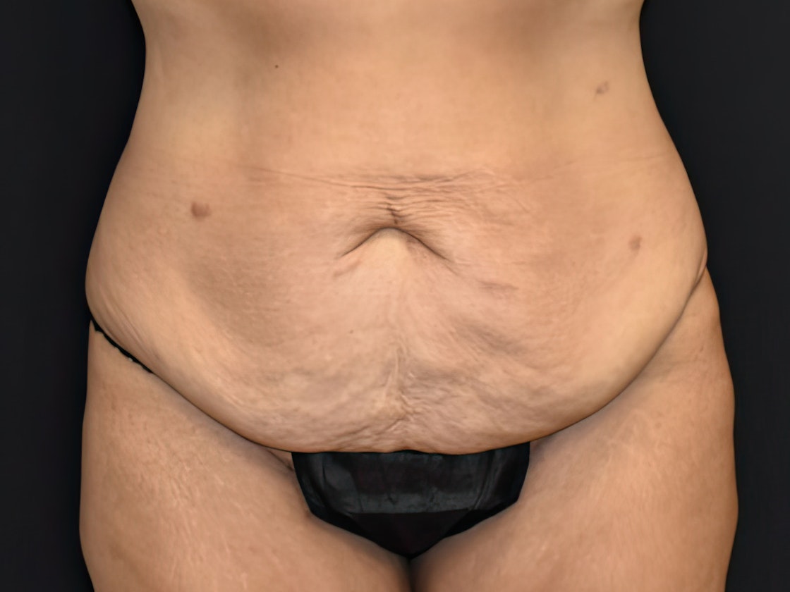 Tampa patient before tummy tuck
