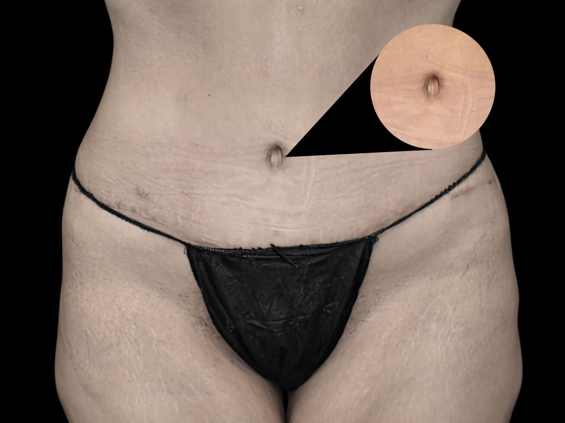Close-up of belly button after a tummy tuck