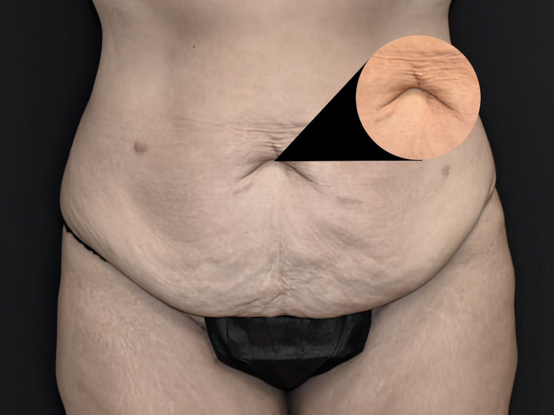 Close-up of belly button before a tummy tuck