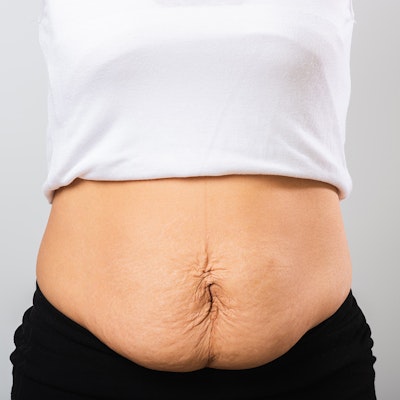 midsection with crepe-textured skin