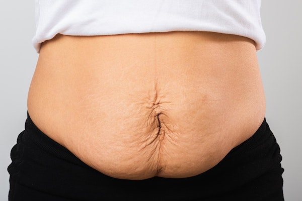 midsection with crepe-textured skin