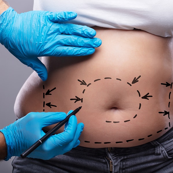 drawing on belly, planning lipo