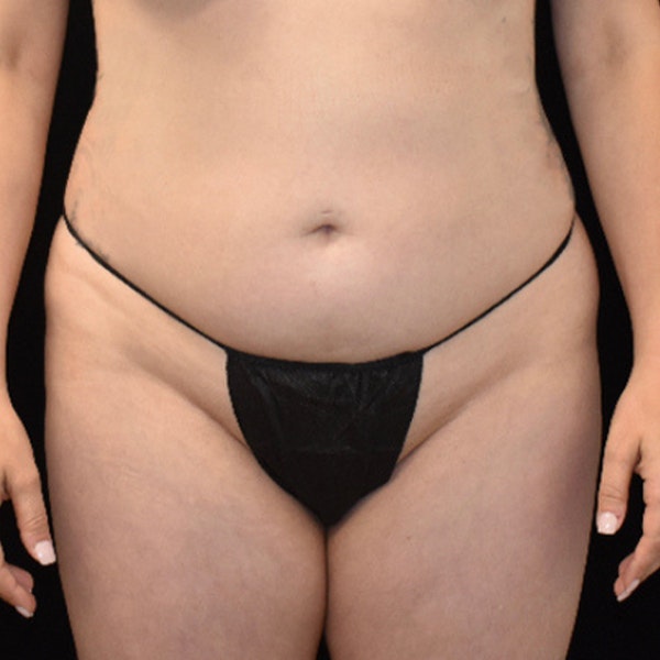 a woman's abdomen before liposuction