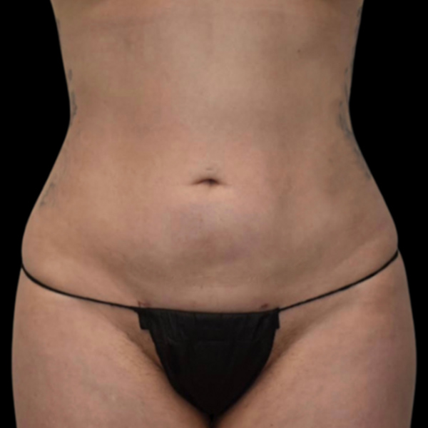 a woman's abdomen after liposuction