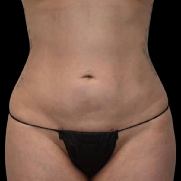 a woman's abdomen after liposuction