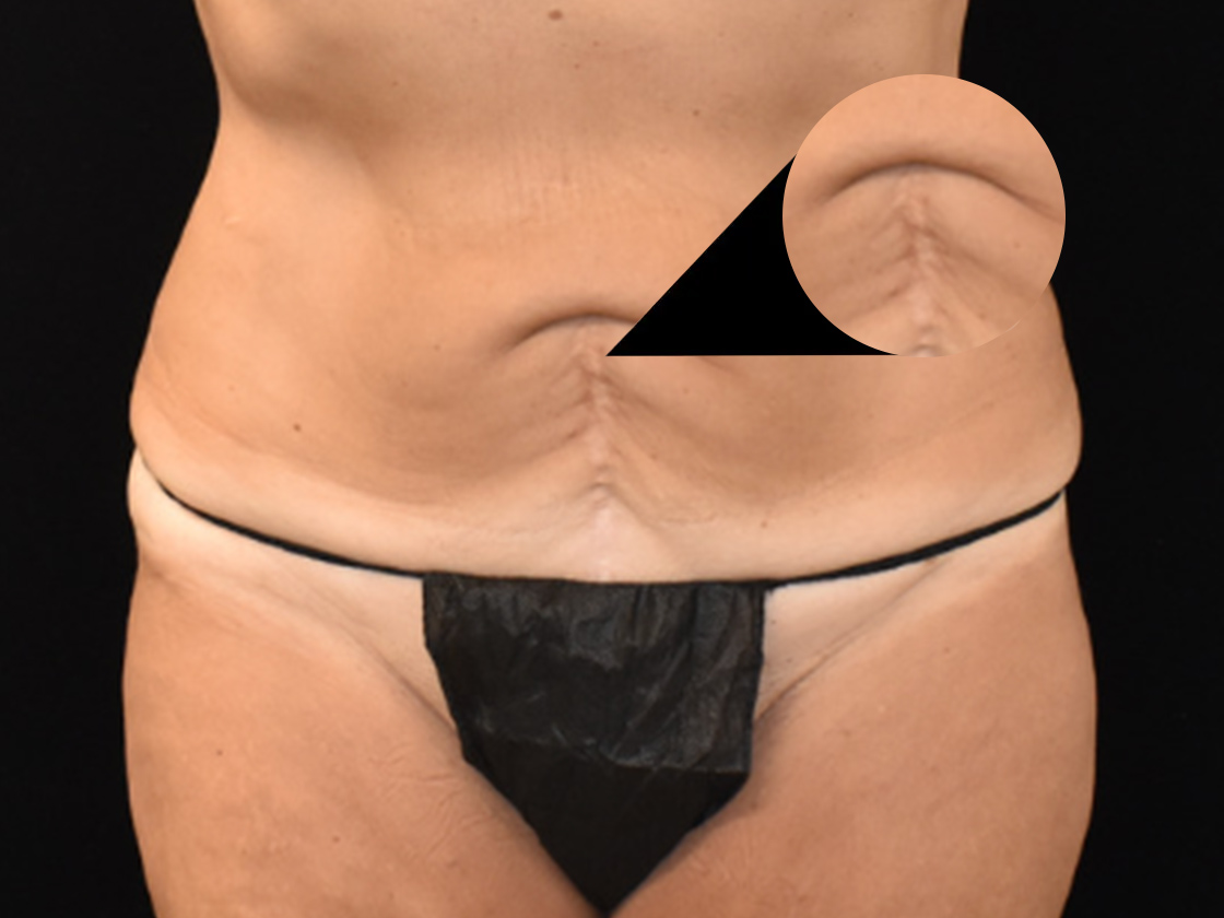 Dr. Brown's Patient Before Tummy Tuck