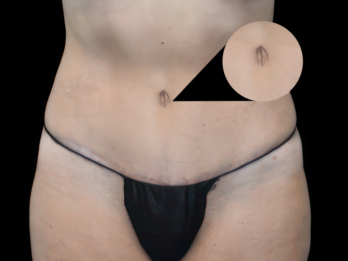 Dr. Brown's Patient After Tummy Tuck