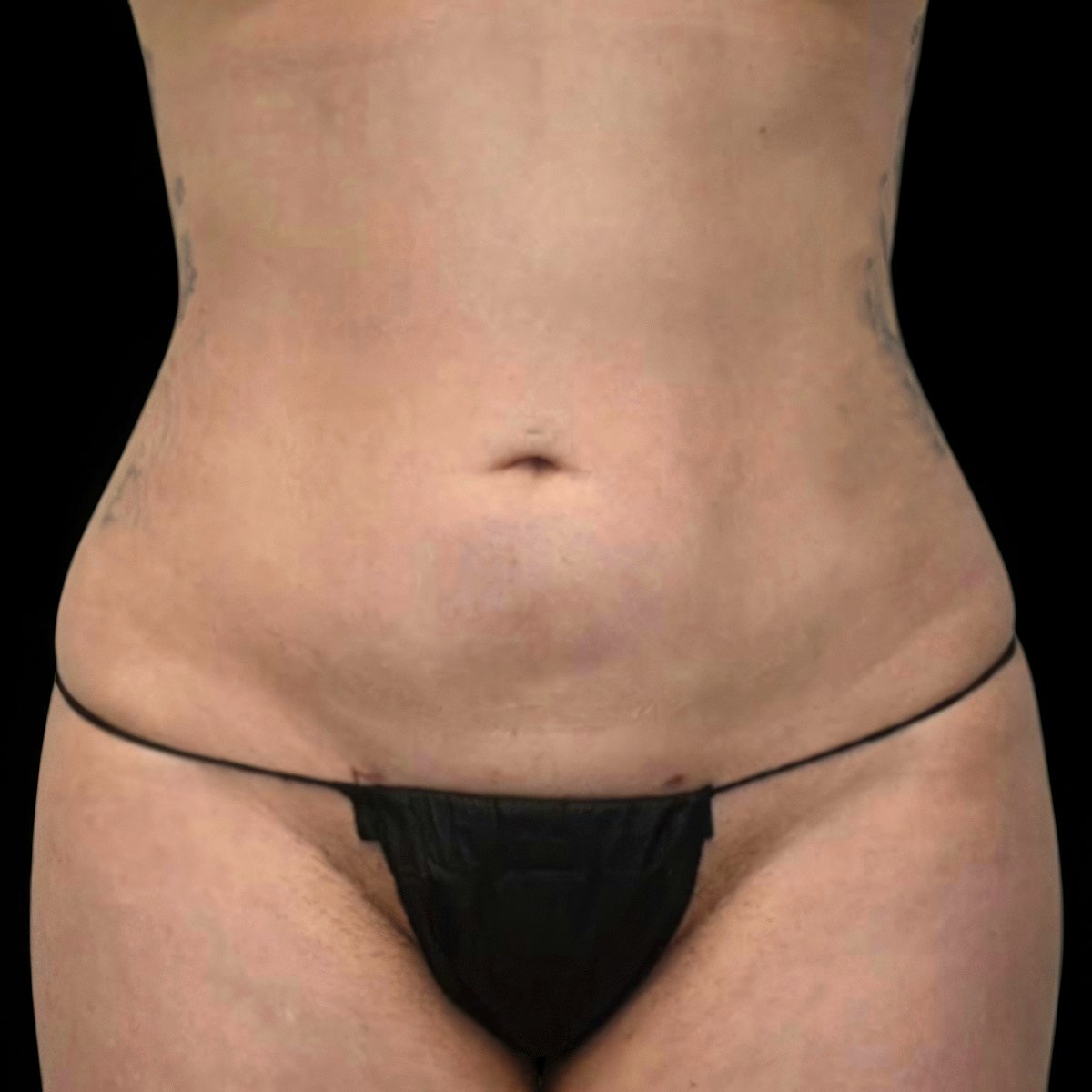 a woman's abdomen after liposuction