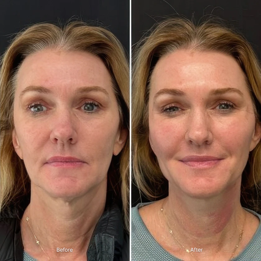 Before and after results for TRL Laser Skin Resurfacing