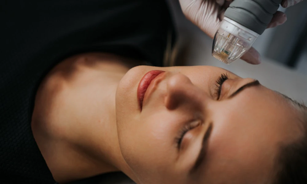 Woman receiving RF microneedling