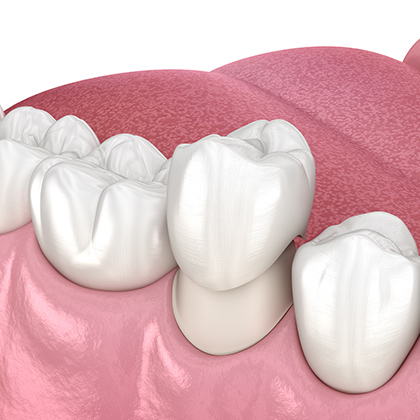 Dental Crown illustration