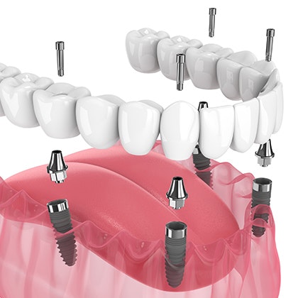 Placement of an implant-supported denture