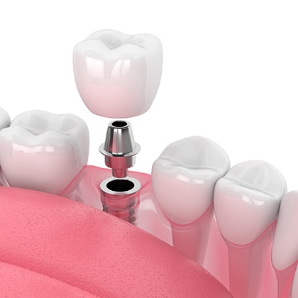 Patient getting an implant-supported crown