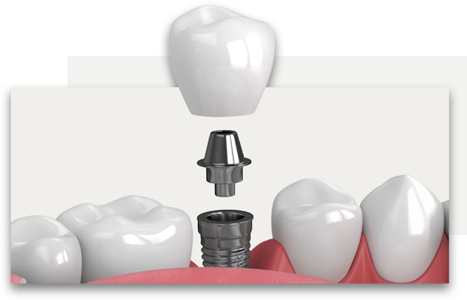 implant supported crown