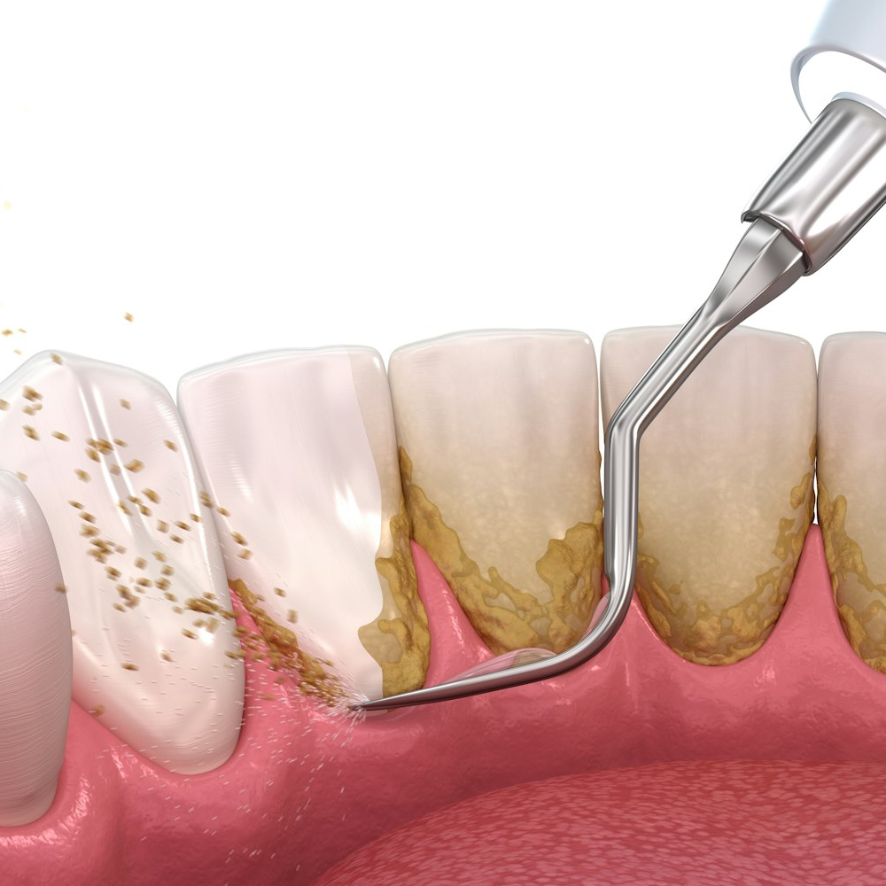 Periodontal Treatment illustration