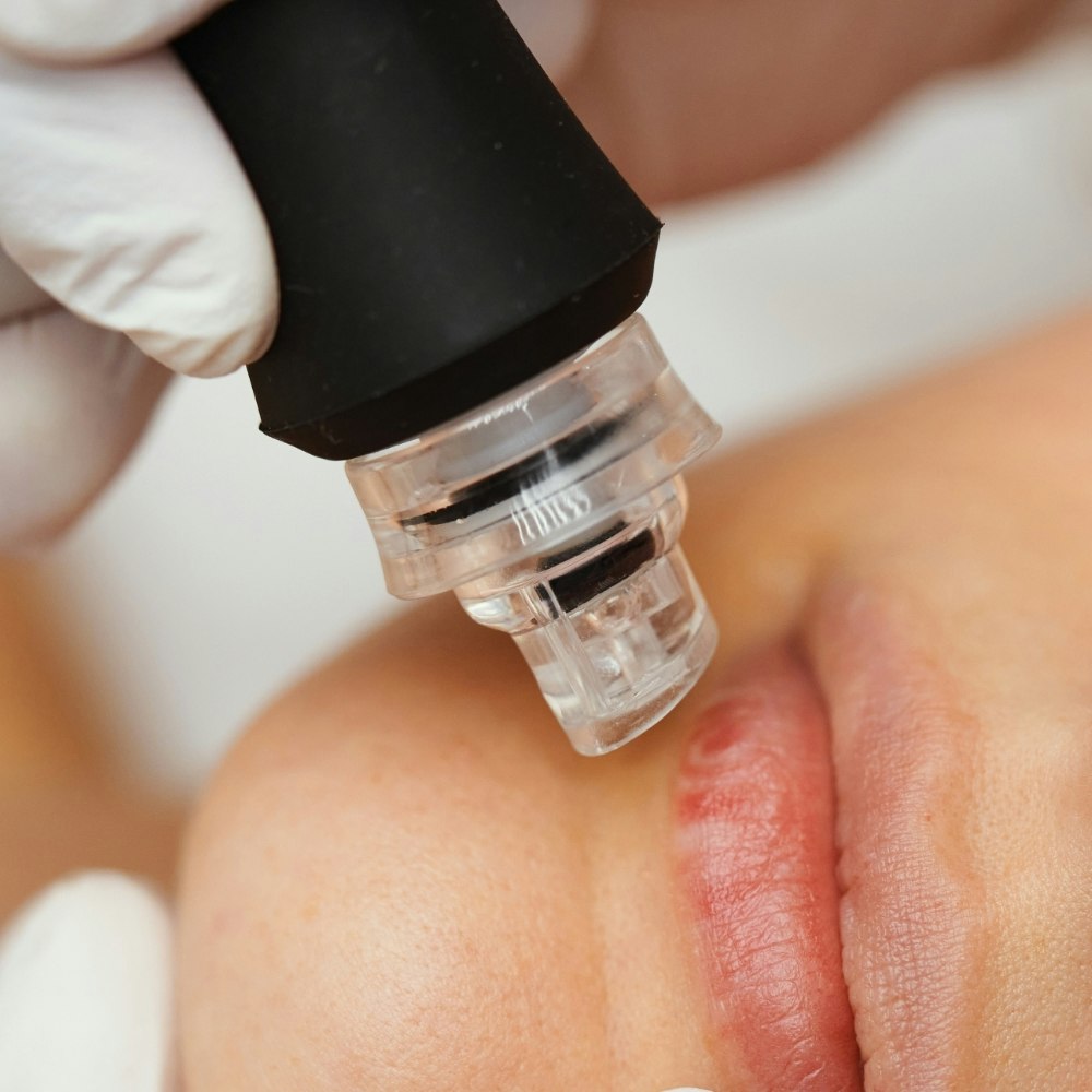 Close up of microdermabrasion treatment