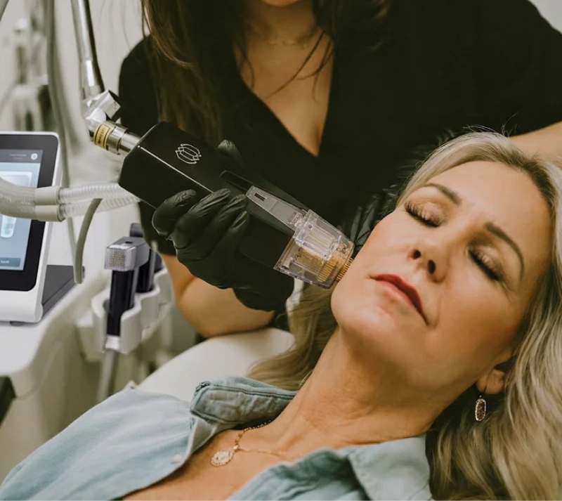 Morpheus8 treatment