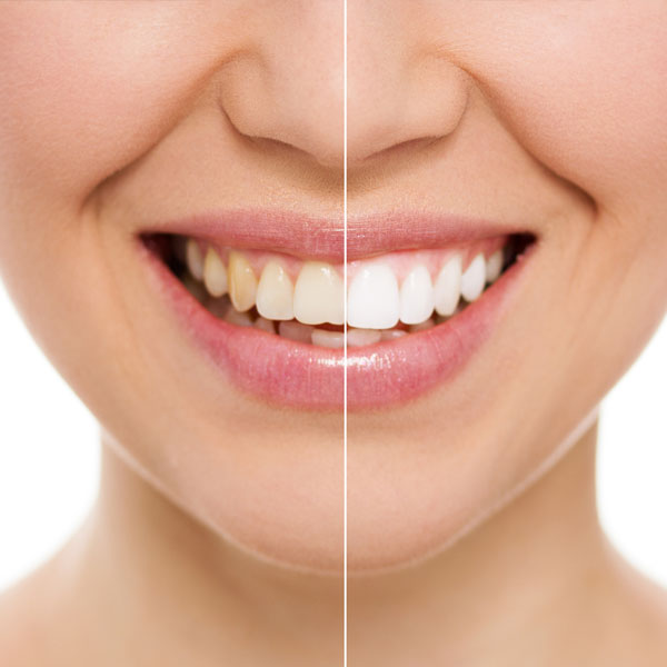 Smile before and after whitening