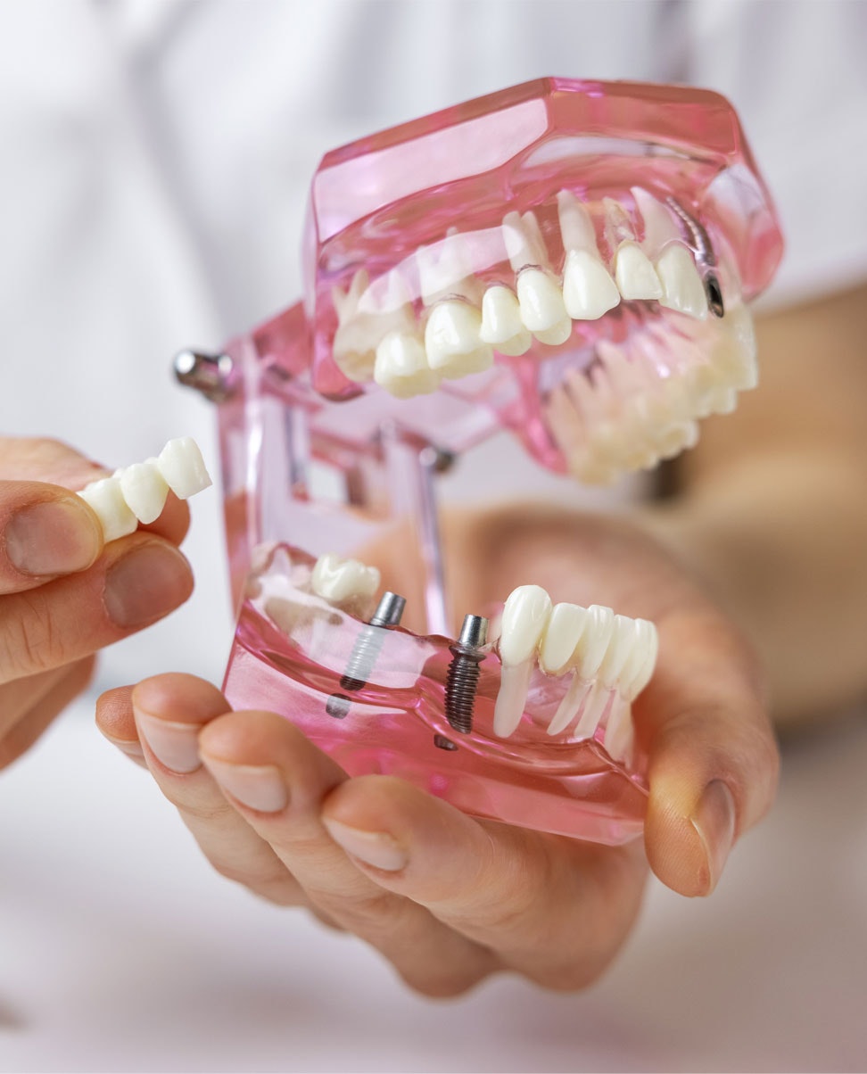 Dental Bridge Basics