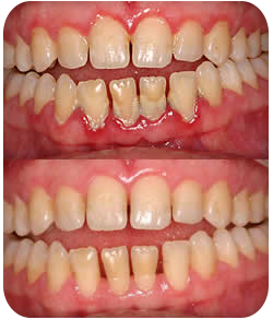 Periodontal disease treatment with Nashville gum disease specialist Dr. Nabors and Dr. Clegg