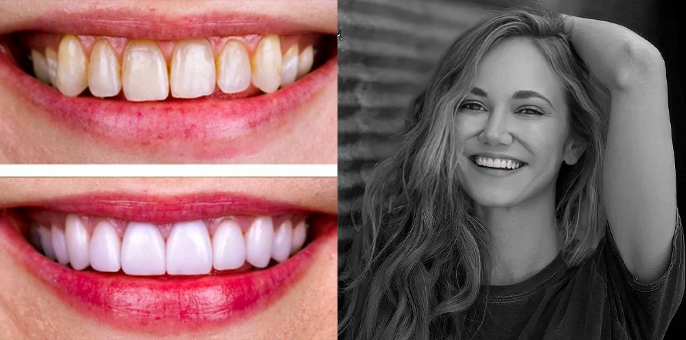 Before and After Smile Design