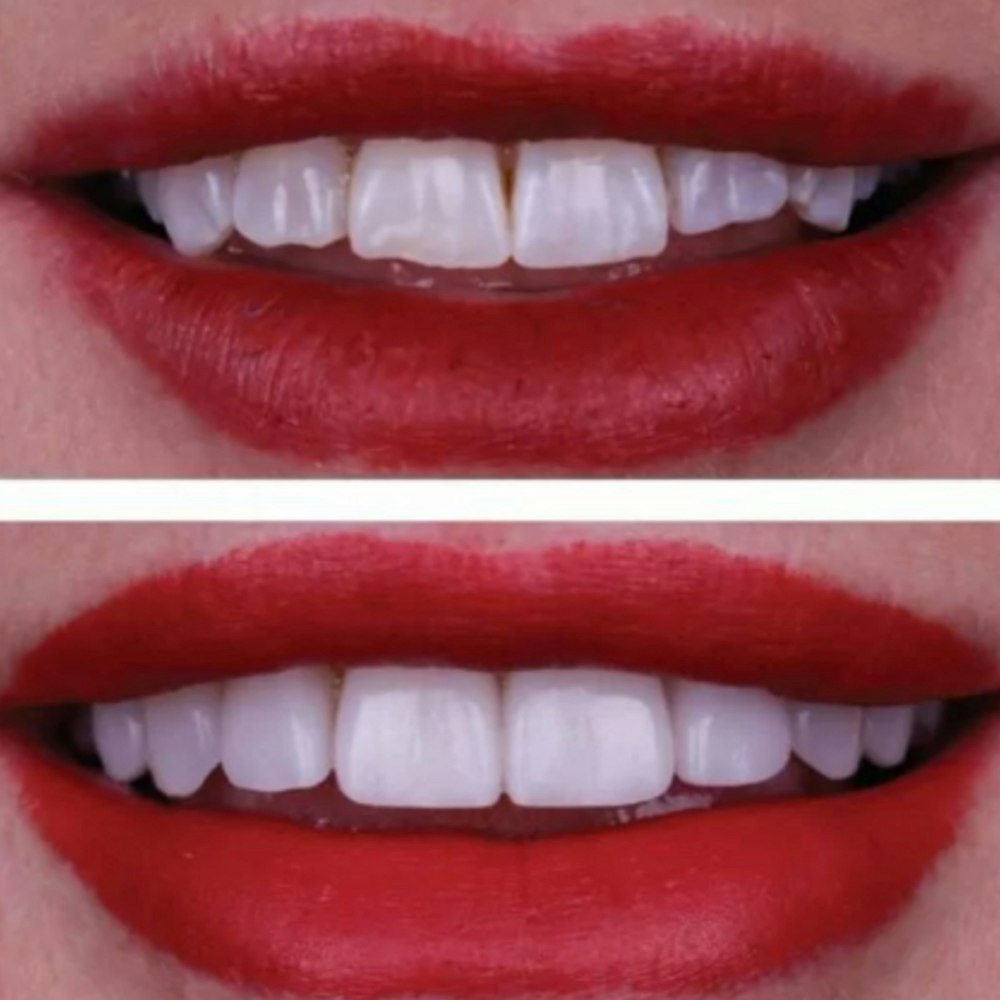 Smile before and after cosmetic dentistry