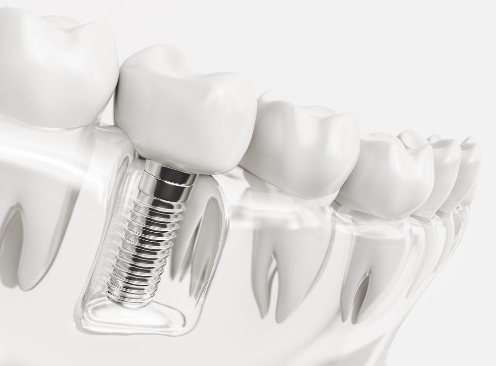 clear 3d render of dental implants