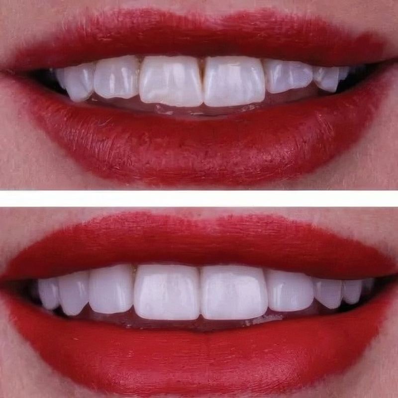 Before and after teeth