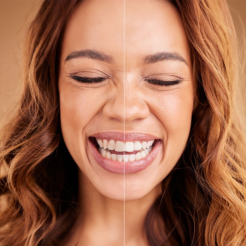 Smiling woman before and after teeth whitening