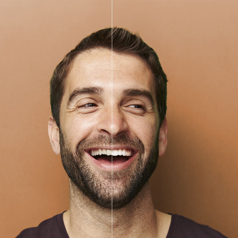 Laughing man after dental bonding