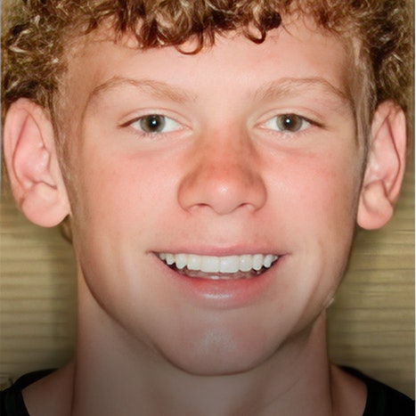 Smiles by Myles tooth-colored filling patient