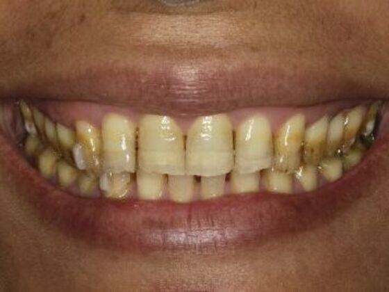 Smiles by Myles patient before porcelain veneers