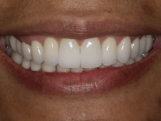 Smiles by Myles patient after porcelain veneers