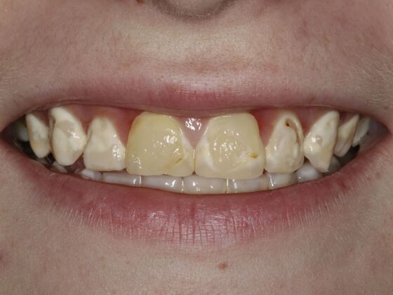 Smiles by Myles patient before porcelain veneers and crowns