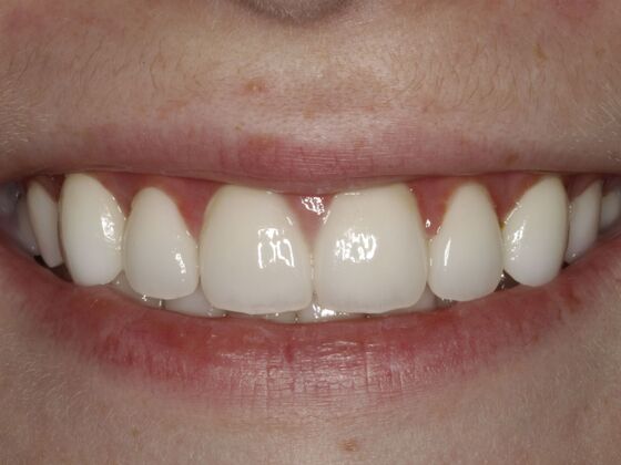 Smiles by Myles patient after porcelain veneers and crowns