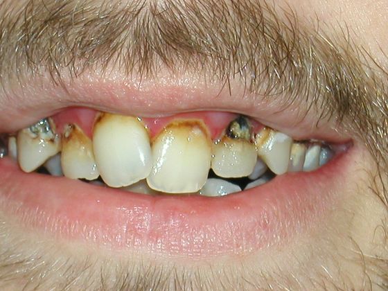 Smiles by Myles patient before full mouth reconstruction