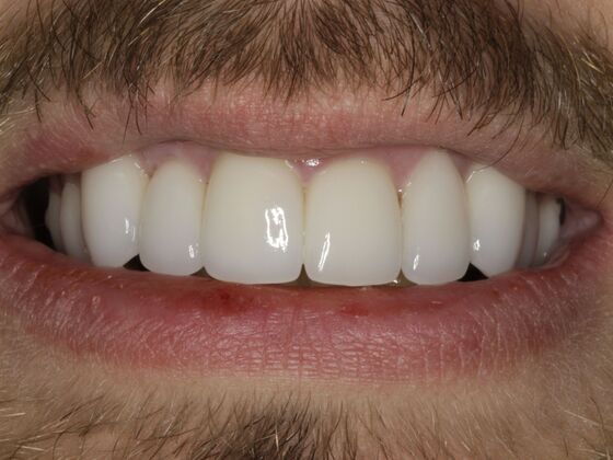 Smiles by Myles patient after full mouth reconstruction