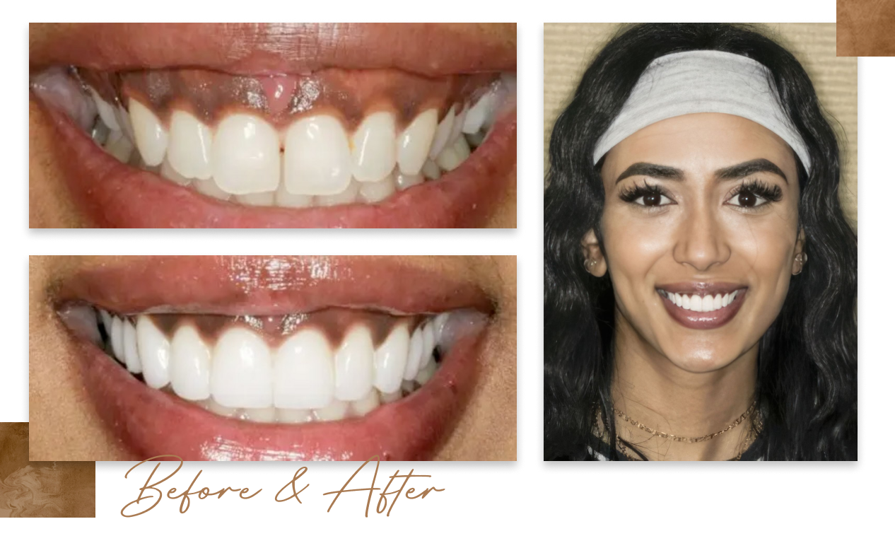 Before and after a smile makeover