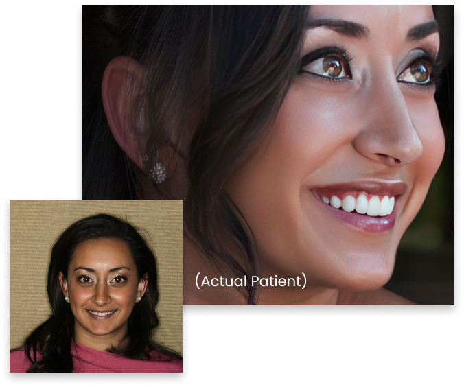 Smiles by Myles patient before and after veneers