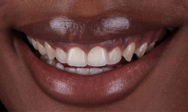 before cosmetic dental work