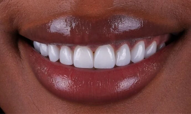 after cosmetic dental work