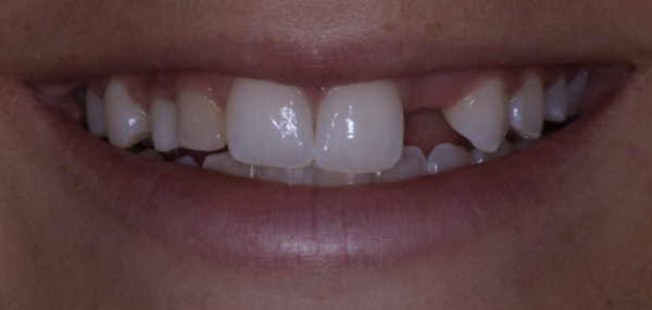 Before dental implants