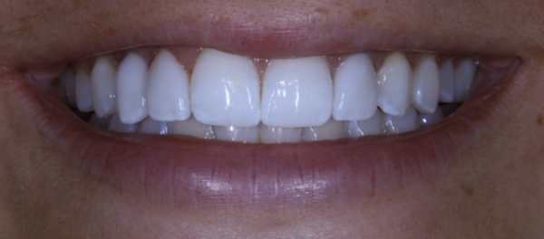 After dental implants