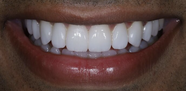 After veneers