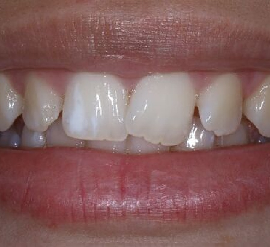 Before Invisalign