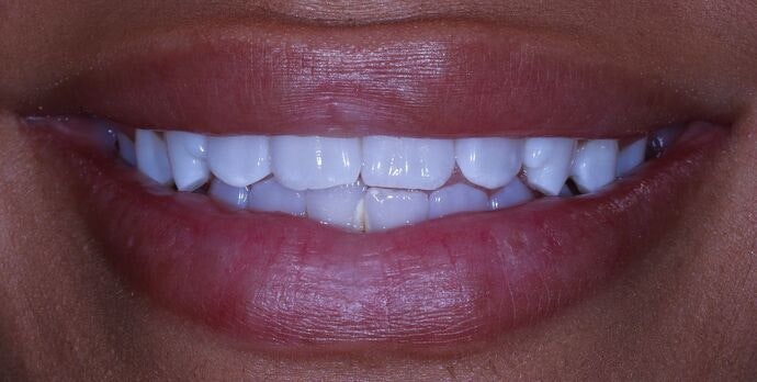 Janira before veneers