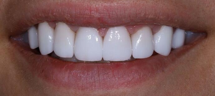 After Veneers