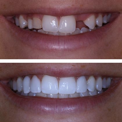Dr. Todd Goldstein's patient Nicole before and after dental implants