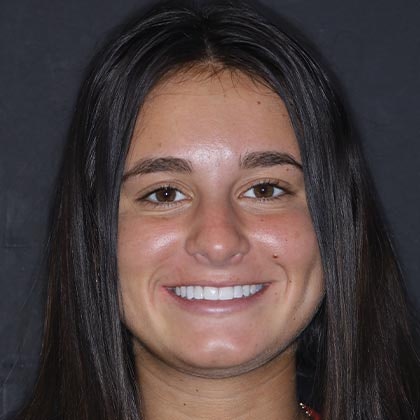 Dr. Todd Goldstein's patient Nicole after dental implants